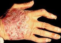 关节病型银屑病