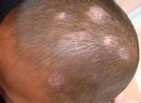 头皮型银屑病