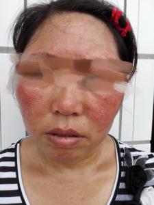 激素依赖性皮炎